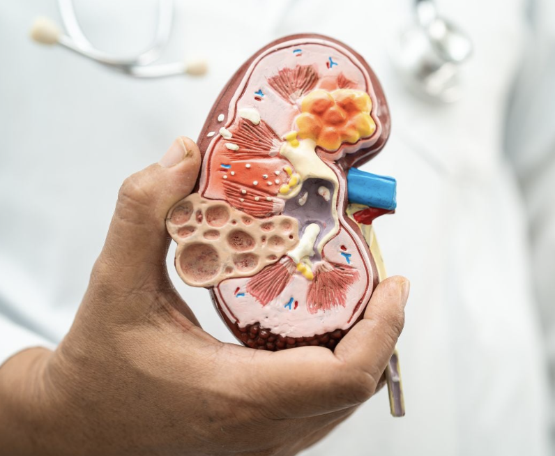 CÁNCER DE RIÑÓN, EL RIESGO SILENCIOSO PARA TRABAJADORES EXPUESTOS A SOLVENTES